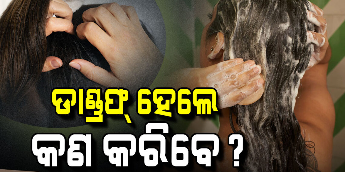 ମୁଣ୍ଡରେ ରୁପି ହେଉଛି କି? ଆପଣାନ୍ତୁ ଏହି ଉପାୟ