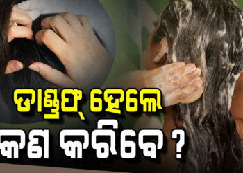 ମୁଣ୍ଡରେ ରୁପି ହେଉଛି କି? ଆପଣାନ୍ତୁ ଏହି ଉପାୟ