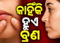 ଭୁଲରେ ଵି ଲଗାନ୍ତୁନି ଏହିସବୁ ଜିନିଷ, ନହେଲେ ଭର୍ତ୍ତି ହୋଇଯିବ ବ୍ରଣ